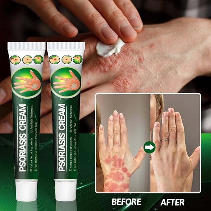 Psoriasis Cream - Herbal Plant Extracts 20g