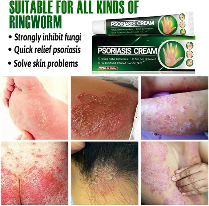 Psoriasis Cream - Herbal Plant Extracts 20g